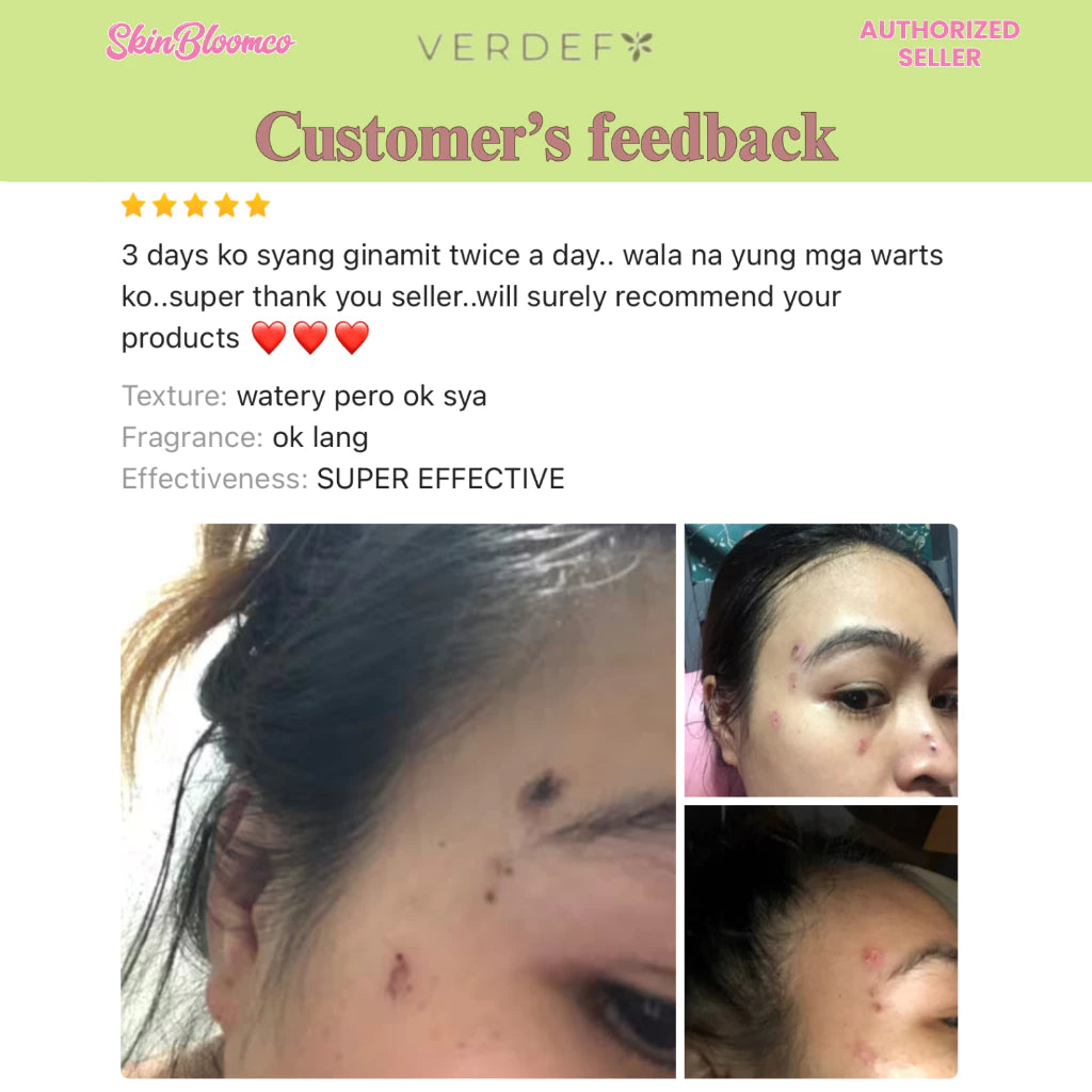 VERDEFY ULTIMATE DUO NEW STRONG KASOY CREAM & SCAR CREAM 5G FOR WARTS, MOLE, SKINTAGS, SYRINGOMA